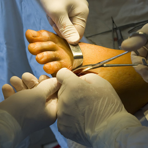 Reconstructive Foot and Ankle Surgery