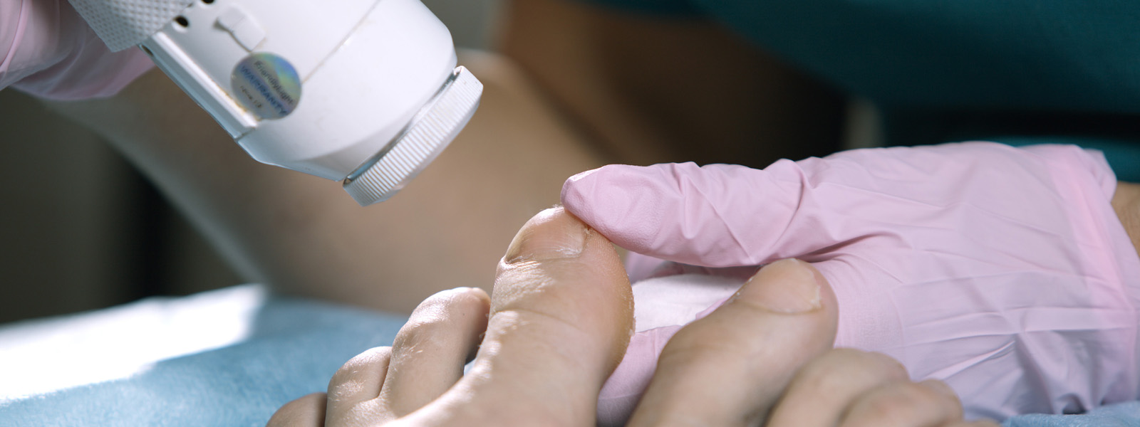 Laser Toenail Fungus Treatment